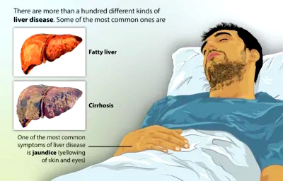 Liver Disease image source: physio-pedia.com